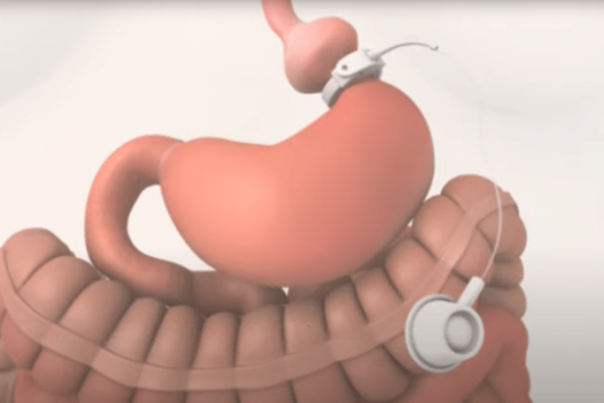 gastric_band_surgery